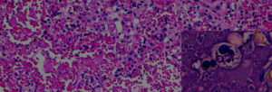 celulas histoplasmosis enfermedad viajes cuevas rapel