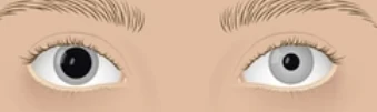 Anisocoria