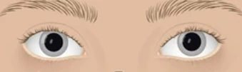 mydriasis